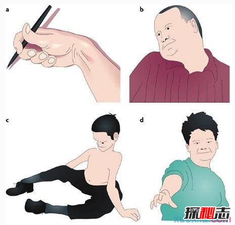 中國世界首例舞蹈豬,亨廷頓氏舞蹈癥是什么??？